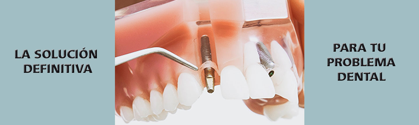 ejemplo gráfico de implantes dentales